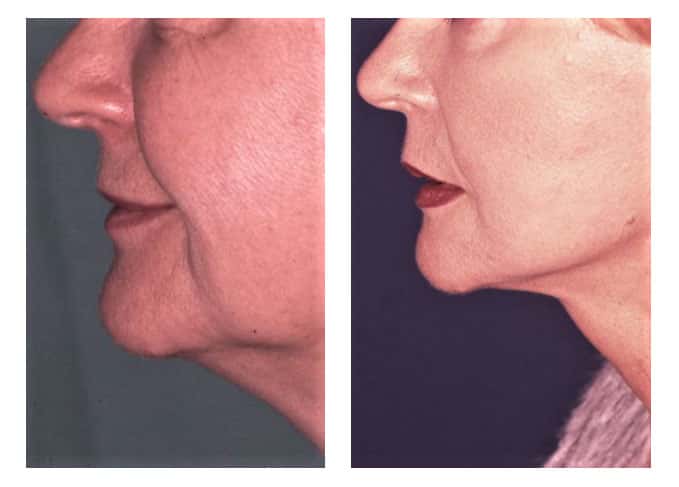 Patiente avant et après un lifting cervico-facial. © Dr Mitz, tous droits réservés 