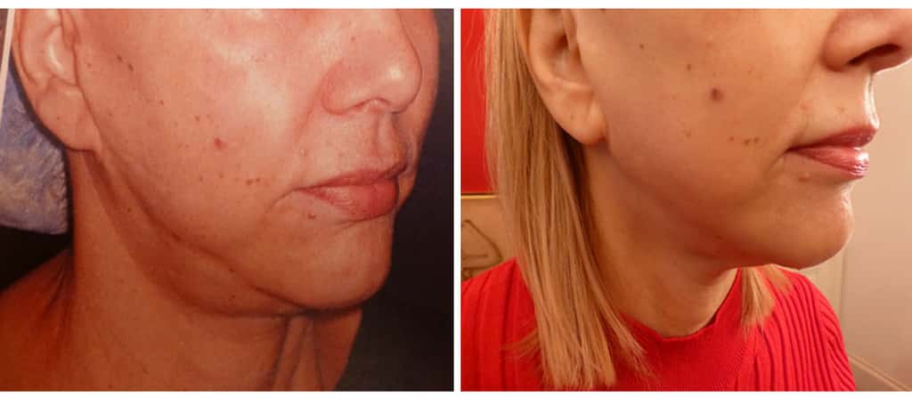 À gauche, profil de visage avant lifting cervico-facial biplan. À droite, profil de visage un an après lifting cervico-facial biplan. © Dr Mitz, tous droits réservés