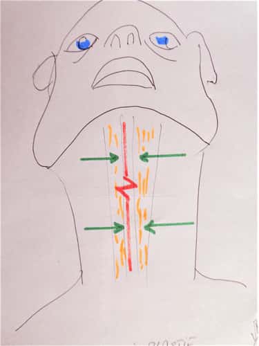 Principes de la cervico-plastie verticale. © DR Mitz, tous droits réservés