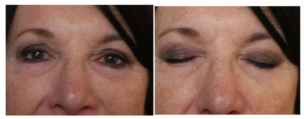 Résultat de la même patiente après deux mois à gauche et les yeux fermés à droite. © Dr Mitz, tous droits réservés
