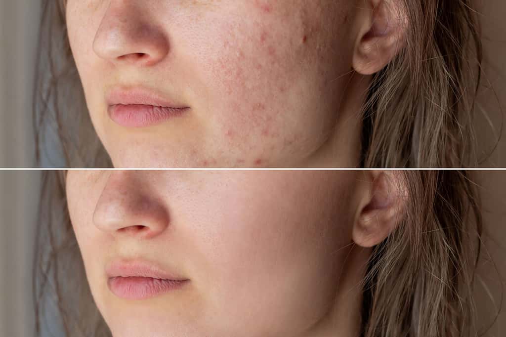 Acné du visage avant et après traitement. © Марина Демешко, Adobe Stock 