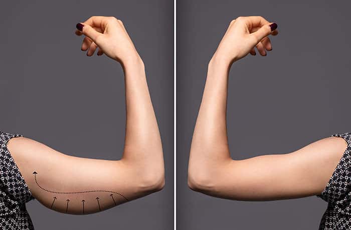 Avant et après une brachioplastie. © Alessandro Grandini, Adobe Stock
