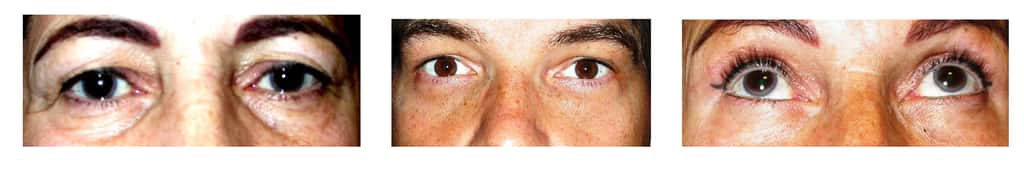 1/ Cernes sous les yeux - 2/ Après correction par blépharoplastie inférieure de re-tension - 3/ Même patiente en post-op regard vers le haut © Dr. Mitz, tous droits réservés