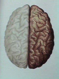 Latéralité du cerveau et dépression