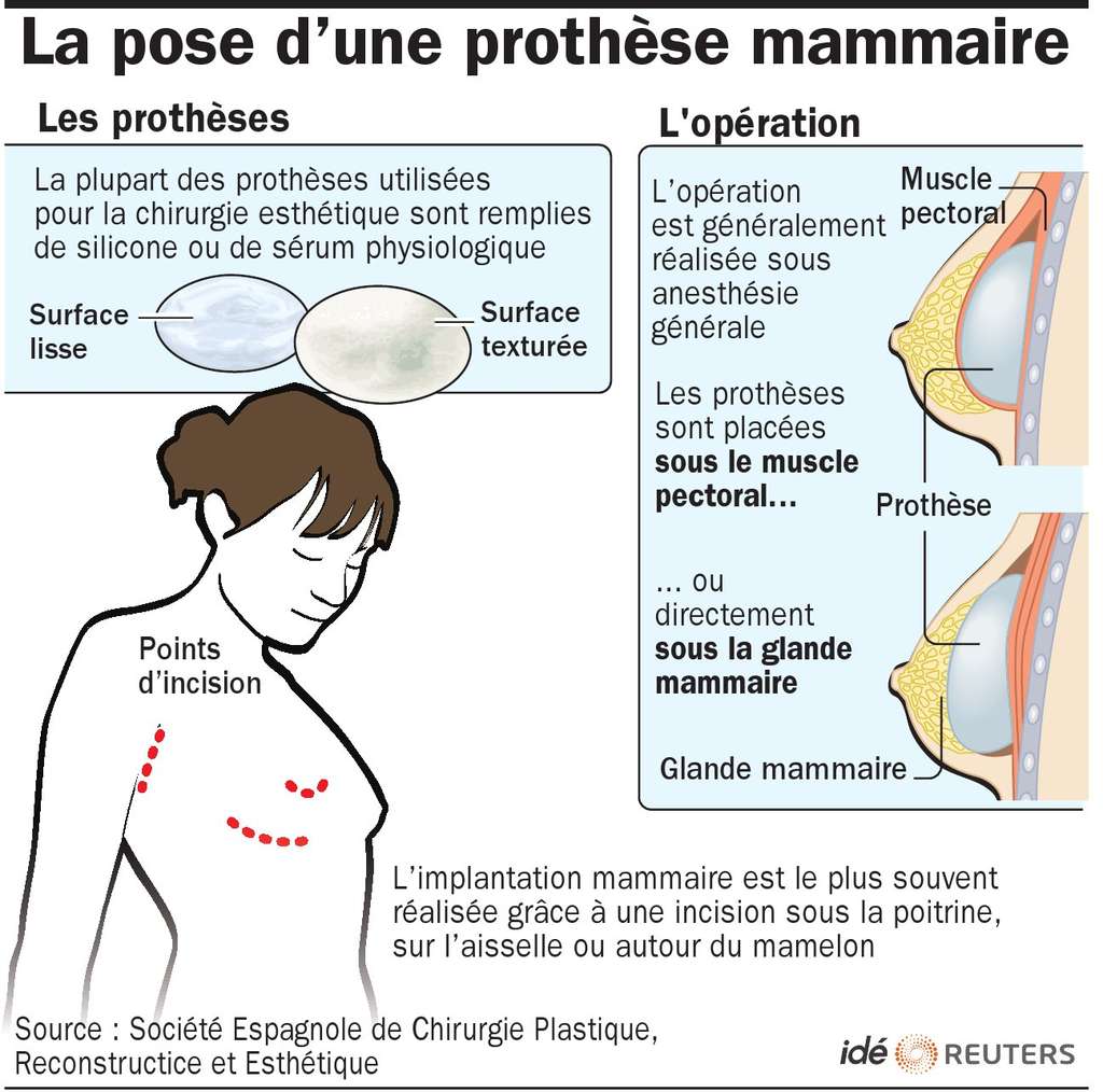 On estime à environ 500.000 le nombre de Françaises ayant subi une opération de chirurgie pour se faire poser un implant mammaire. Cette illustration explique les procédés utilisés. © Idé 