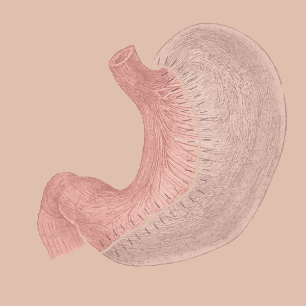 Schéma d'une gastrectomie longitudinale (sleeve). © Kwipedl Cyop, <em>Wikimedia commons,</em> CC 4.0