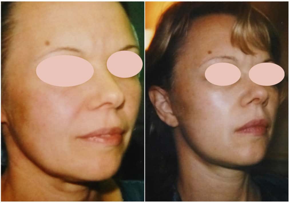 À gauche, patiente jeune demandeuse de rétablissement de l’ovale du visage par chirurgie efficace. À droite, résultat obtenu par microlift six mois après l'opération. © Dr Mitz, tous droits réservés 