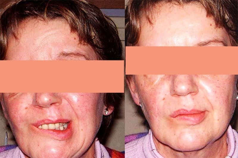 Avant injection de Botox, à gauche. Après injection, à droite. © Dr. Mitz, tous droits réservés 