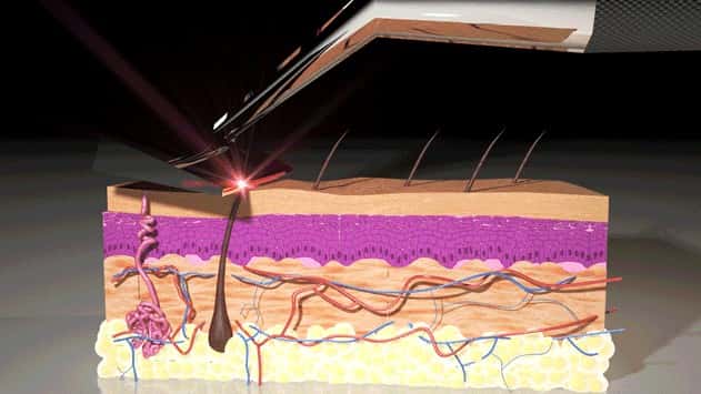 Skarp Technologies dit avoir identifié une longueur d’onde lumineuse à laquelle tous les types de poils sont sensibles. Au contact du laser, le poil est sectionné, sans brûlure ni dégagement d’odeur assurent les concepteurs. © Skarp Technologies