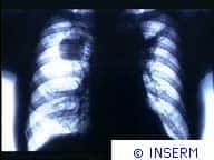 Radiographie du cancer du poumon, montrant une tumeur (tache noire sur le poumon droit).Crédit : INSERM