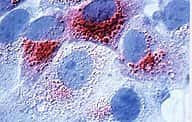 Catepsine hyperexprimée dans des cellules de cancer du seinCrédits : INSERM