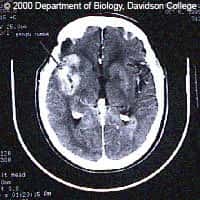 Tumeur du cerveau vue au scanner.