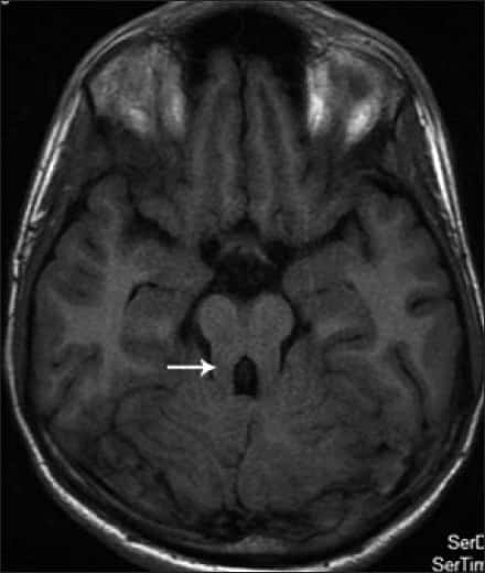 Visible sur l’IRM, une molaire dans le cerveau : c'est le signe du syndrome de Joubert. © Ann Indian Acad Neuro