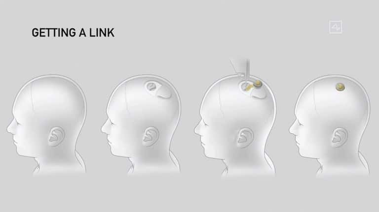 Schéma de Neuralink montrant comment la puce sera implantée dans le cerveau humain. © Neuralink, AFP