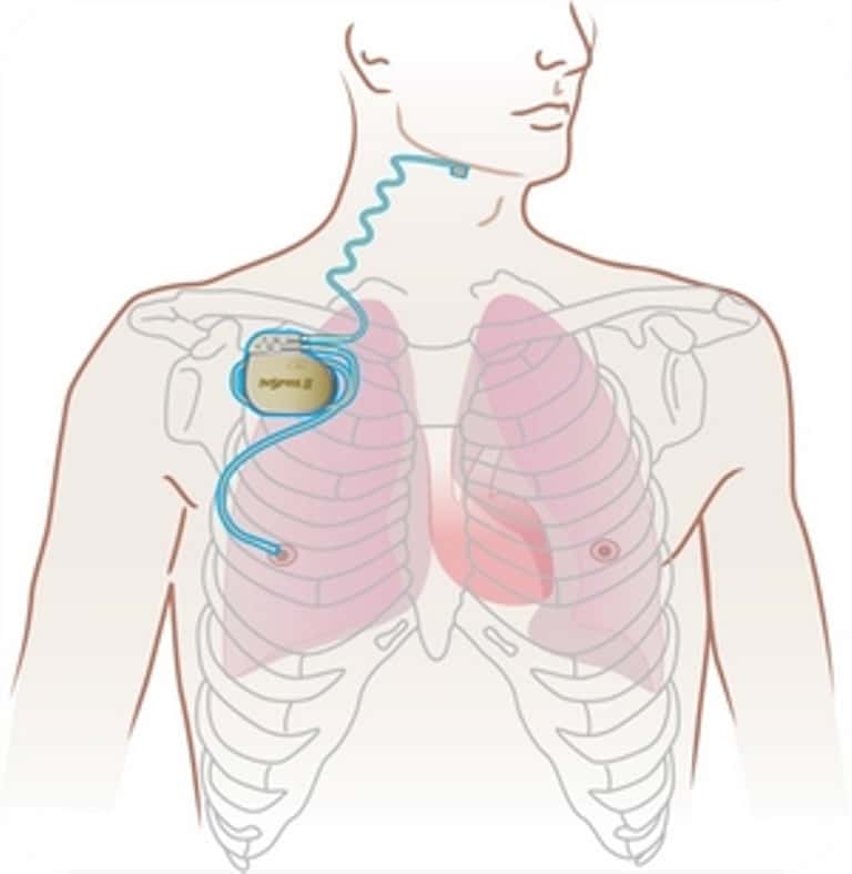 Comme les personnes souffrant de problèmes cardiaques, un pacemaker adapté améliore la qualité du sommeil des victimes d'apnées du sommeil. © Destination Santé