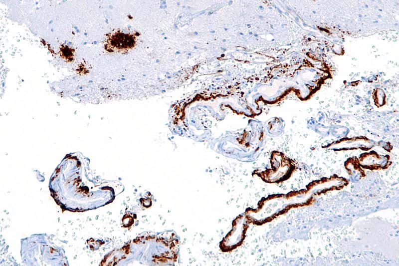 Cette image au microscope montre les plaques séniles (en marron) qui se forment entre les neurones du cortex cérébral. En elles-mêmes, elles pourraient ne pas être nocives, mais les bêta-amyloïdes qui les composent auraient auparavant contribué à détruire les synapses entre les neurones. © Nephron, Wikipédia, cc by sa 3.0