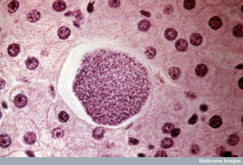 <em>Plasmodium vivax</em>, ici au milieu de cellules hépatiques, est responsable de nombreux cas de paludisme à travers le monde chaque année, mais épargnait jusque-là l'Afrique subsaharienne. © Wellcome Images, cc by nc nd 2.0
