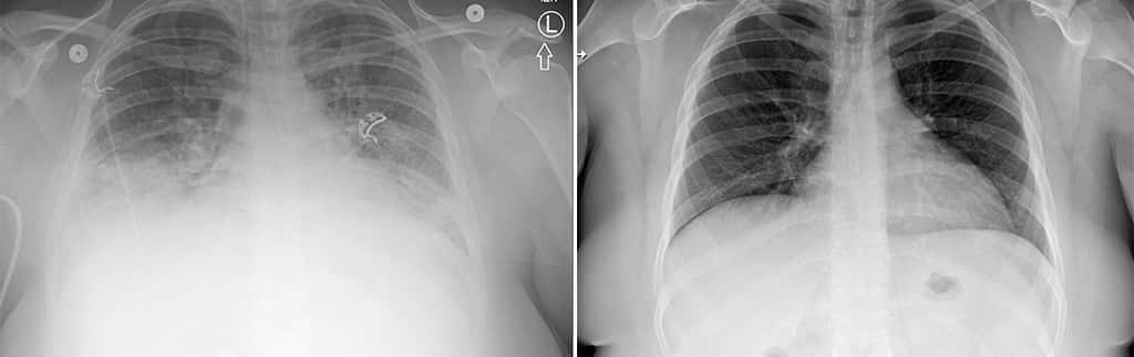 À gauche, le scanner des poumons d’un patient souffrant de la maladie respiratoire liée au vapotage, à droite, le scanner des poumons du même patient après traitement. © Université de l’Utah