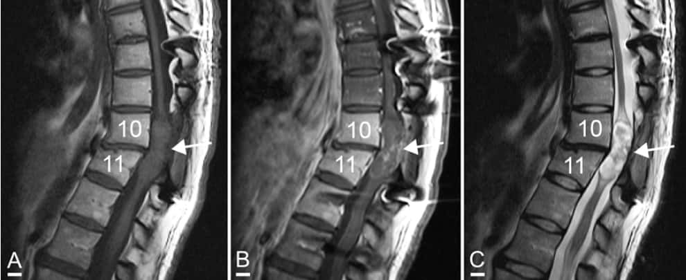 Images IRM sagittales révélant une masse (flèches blanches) sur la moelle épinière développée huit ans après une greffe de cellules souches de muqueuse nasale sur une patiente handicapée moteur. © Brian J. Dlouhy et al.