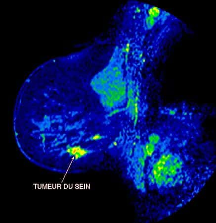 Image couleur d'un cancer du sein. Crédits : perso.wanadoo.fr/association.afrha/icono.htm