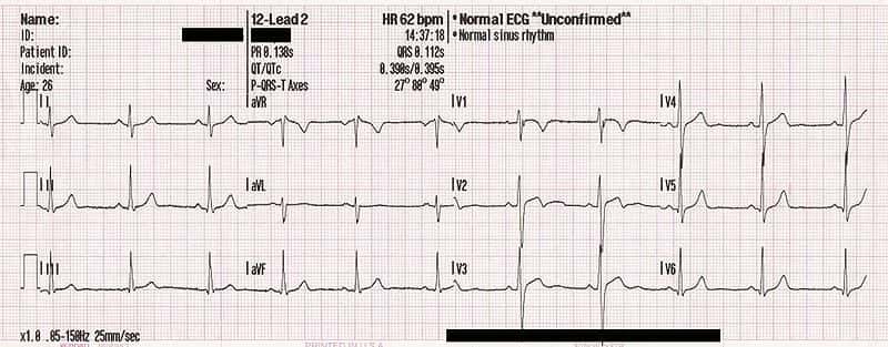 L'électrocardiogramme permet de mesurer la variabilité de la fréquence cardiaque. © MoodyGroove / domaine public 