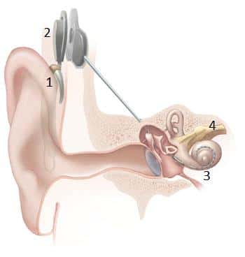 Les implants cochléaires sont complexes : les sons sont captés par le microphone (1), transformés en signaux électriques et transmis jusqu'à l'émetteur (2). Les ondes radio sont captées sous la peau, l'information est transmise par un fil électrique jusqu'à la cochlée (3), qui active le nerf auditif (4). © Licence <em>Commons</em>