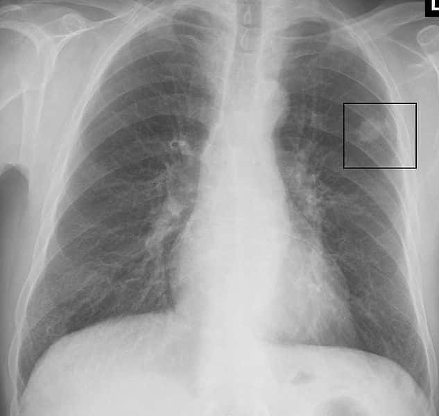 Le cancer du poumon (ici visible dans l'encadré) est un des cancers les plus mortels, avec seulement 10% de survie cinq ans après le diagnotic. © Lange123 / Licence Creative Commons