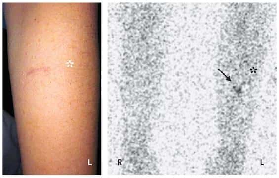 L'image de gauche correspond à la photographie du bras gauche de la patiente. L'image de droite correspond à l'observation des deux bras (R = bras droit ; L = bras gauche) de la patiente par scintigraphie. La flèche indique la position du marquage et donc des cellules &#946;. L'étoile indique la position de la cicatrice laissée par l'implantation des cellules. © NEJM