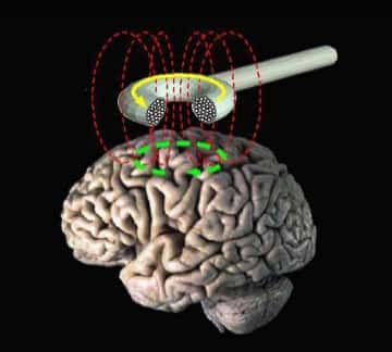 La stimulation magnétique transcrânienne est peut-être la nouvelle arme pour traiter durablement la dépression. © DR