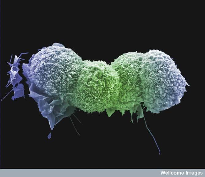 Le cancer du poumon (dont on voit ici des cellules tumorales), possède un taux de mortalité élevé et en augmentation chez les femmes. © Anne Westin, LRI, CRUK, CC by-nc-nd 2.0