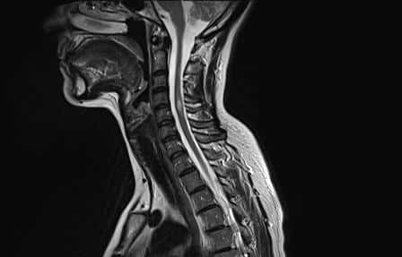 La sclérose en plaques touche la moelle épinière, visible sur cette IRM. © ARSEP