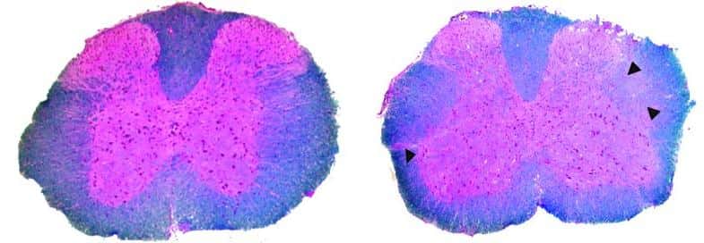 Chez les souris modèles de la sclérose en plaques, la démyélinisation du système nerveux central est moins observée lorsqu'elles sont vaccinées (à gauche) que lorsqu'elles ne le sont pas (à droite). © <em>Journal of Clinical Investigation</em>