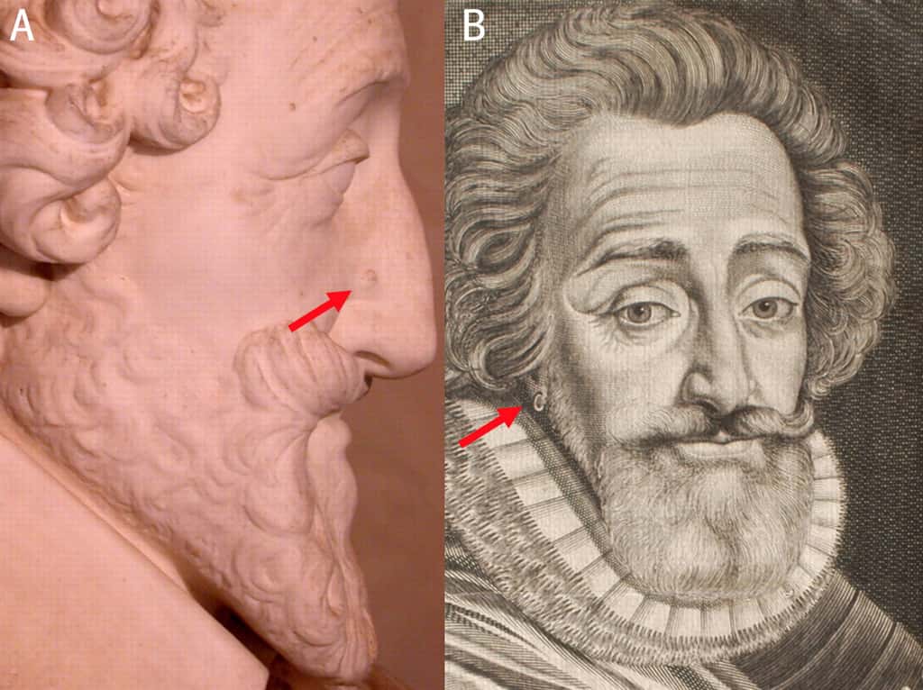 Le bon roi Henri avait une petite marque sur l'aile droite du nez, et le lobe de son oreille droite avait été percé, deux détails retrouvés sur la tête embaumée. © P. Charlier <em>et al.</em>/BMJ