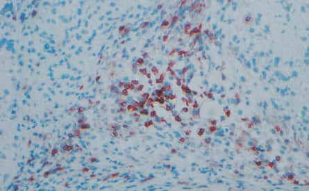 Les cellules souches sont attaquées par les lymphocytes T (taches brunes). © Yang Xu, Université de Californie à San Diego, <em>Nature</em>