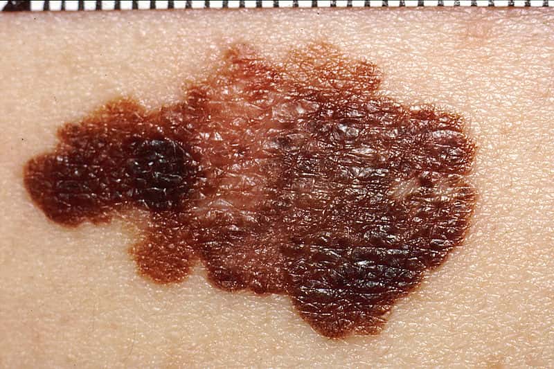 Les mélanomes forment des taches noires sur la peau. © <em>Wikimedia Commons</em>