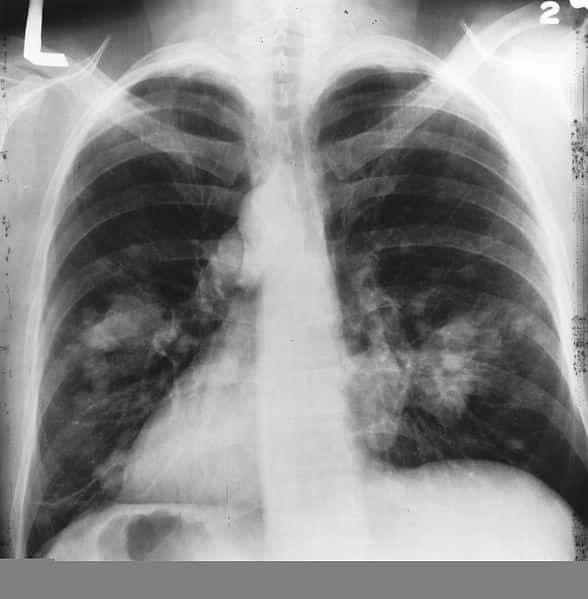 Les radiographies annuelles&amp;nbsp;du thorax ne seraient pas efficaces pour réduire la mortalité due au cancer du poumon. Sur cette radio, les&amp;nbsp;taches claires sur les&amp;nbsp;poumons montrent un probable cancer du poumon.&amp;nbsp;© Wikipédia DP

Le dépistage par radio&amp;nbsp;ne sauve pas plus du&amp;nbsp;cancer du poumon
Au cours d&#039;une période de suivie de treize ans close en 2009, ces chercheurs ont diagnostiqué 1.696 cancers du poumon dans le groupe soumis à une radiographie annuelle et 1.620 dans le groupe témoin.

Les taux de mortalité qui ont&amp;nbsp;résulté de ces cancers observés dans ces deux groupes au cours des treize années ont été quasiment identiques avec 1.213 décès chez ceux qui ont eu une radiographie annuelle et 1.230 décès dans le groupe témoin.

La distribution des différents types de tumeurs dans les deux groupes était aussi similaire avec respectivement 41 % d&#039;adénocarcinomes, 20 % de carcinome malpighien, 14 % de carcinome à petites cellules, 5 % de carcinomes à grandes cellules et 20 % d&#039;autres variantes d&#039;épithéliome à grandes cellules.
 Le dépistage par tomodensitométrie serait plus efficace que les radios de poumons pour détecter les petites tumeurs : il réduirait en effet le taux de mortalité du cancer du poumon de 20 %.&amp;nbsp;©&amp;nbsp;Blog story,&amp;nbsp;Flickr CC by nc-nd 2.0