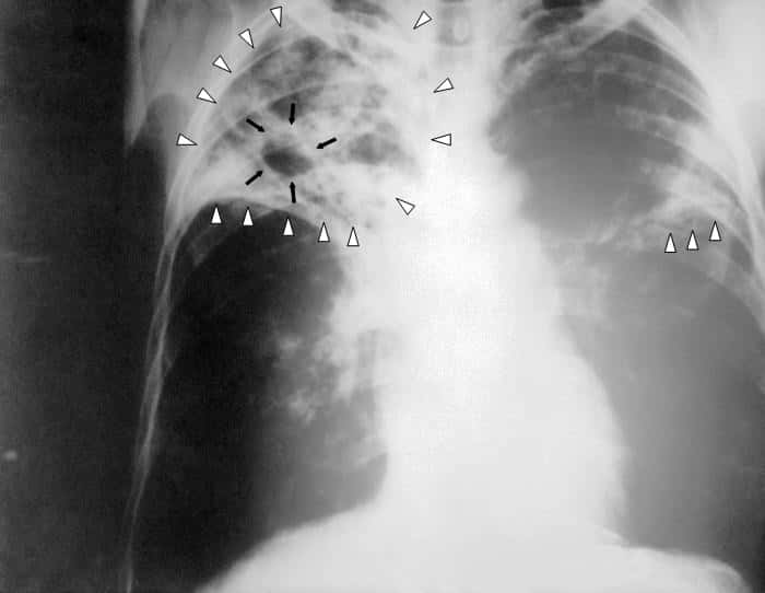 Radiographie d'un patient ayant une tuberculose pulmonaire bilatérale à un stade avancé. D'ici quelques années peut-être, le diagnostic pourra se faire plus rapidement grâce au nez électronique. © Domaine public