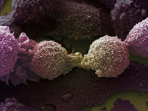 Des cellules du cancer de poumons, ici vues en microscopie électronique à balayage, induisent des changements dans les concentrations des constituants de l'haleine. Ce sont ces modifications qui seraient ciblées par le dispositif. © Wellcome Images, Flickr, cc by nc nd 2.0