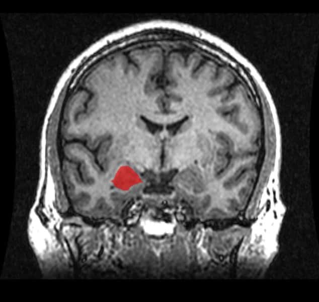 L'amygdale est une région paire du cerveau (ici teintée en rouge) impliquée dans des processus tels que la peur et l'anxiété ou l'apprentissage associatif. On la qualifie souvent de système d'alerte. © Amber Rieder, Jenna Traynor, Geoffrey B Hall, Wikipédia, DP