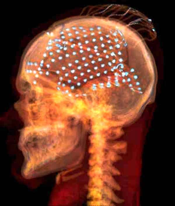 Cette image prise avec un scanner montre les électrodes implantées pour enregistrer l'activité de certaines zones du cerveau afin de tenter de reconstruire les sons entendus à partir des modifications électrochimiques du cerveau. © Adeen Flinker, UC Berkeley