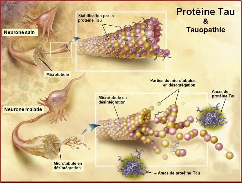 La protéine Tau est présente dans tous les neurones, y compris ceux qui sont sains. Elle stabilise les microtubules, le squelette cellulaire, comme on peut le voir sur le schéma du haut. En revanche, lorsqu'elle est dite pathologique, elle n'assure plus sa fonction et s'accumule dans le neurone, qui finit par mourir. © Zwarck, Wikipédia, cc by sa 2.5