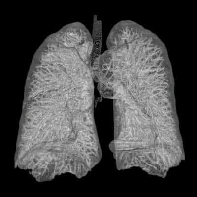 Les poumons sont composés, comme on le voit ici, d'un réseau de bronches. Dans le cas de l'asthme, l'air circule mal du fait d'une bronchoconstriction (réduction du diamètre des bronches) cumulée notamment à une sécrétion importante de mucus, qui réduit davantage le conduit. Les personnes en crise utilisent alors un inhalateur contenant du salbutamol, un bronchodilatateur. © AndreasHeinemann, Wikipédia, cc by sa 3.0