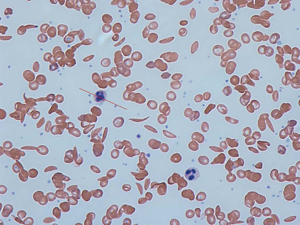 La drépanocytose, également appelée anémie falciforme, est une maladie génétique qui se caractérise par des défauts de la conformation des globules rouges, les cellules du sang chargées de transporter l'oxygène. À cause de mutations au niveau du gène de l'hémoglobine, ces cellules sanguines adoptent une forme caractéristique de faucille au lieu d'être sphériques, comme on peut le voir sur l'image. De ce fait, ils ne peuvent passer à travers les capillaires sanguins, les plus petits vaisseaux de l'organisme. L'oxygène ne peut être délivré aux organes. © Dr Graham Beards, Wikipedia, cc by sa 3.0