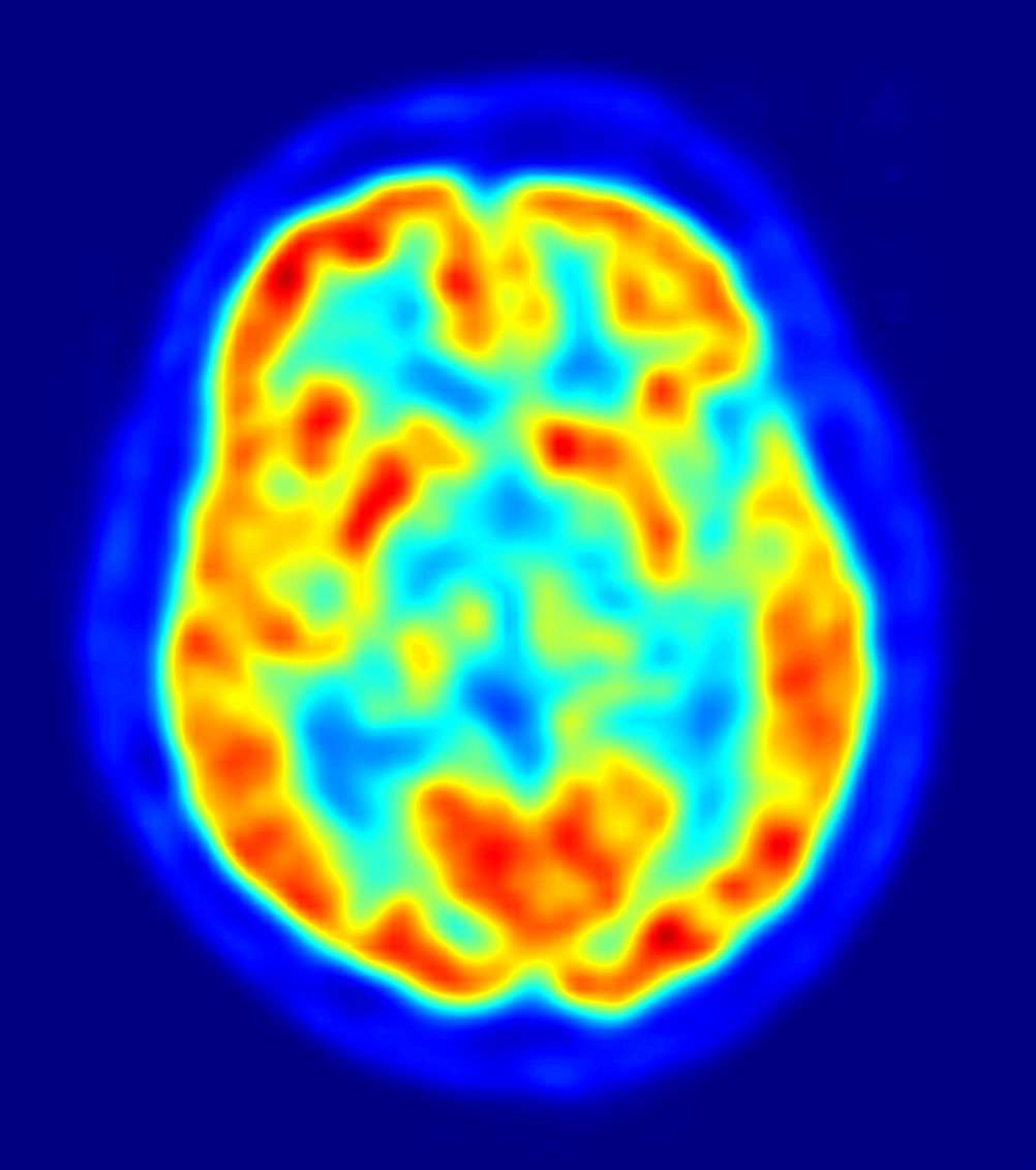 L'imagerie médicale permet d'observer le cerveau in situ, comme on peut le voir sur cet exemple grâce à la tomographie à émission de positons. Cependant, la méthode est bien plus contraignante en test de routine qu'un scanner rétinien. © Jens Langner, DP