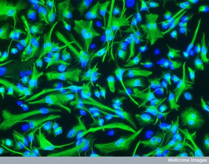 Ces cellules souches cancéreuses en culture proviennent d'une tumeur au cerveau. Le noyau est visible en bleu et le corps cellulaire est vert. Elles sont vraiment néfastes car elles résistent aux thérapies et, étant capables de se multiplier indéfiniment, causent les rechutes. Mais en les utilisant à bon escient dans un vaccin, elles peuvent conduire à leur propre perte et mener le système immunitaire à les cibler plus efficacement. © Steven Pollard, Wellcome Images, Flickr, cc by nc nd 2.0