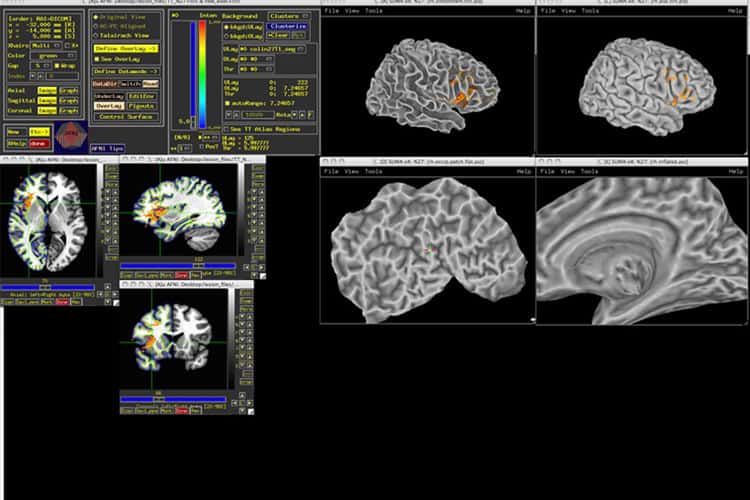 En obtenant de telles représentations du cerveau de leurs différents sujets, les chercheurs sont parvenus à créer une carte de l'intelligence grâce au lien qui existe entre lésion cérébrale et perte de faculté cognitive. © Aron Barbey