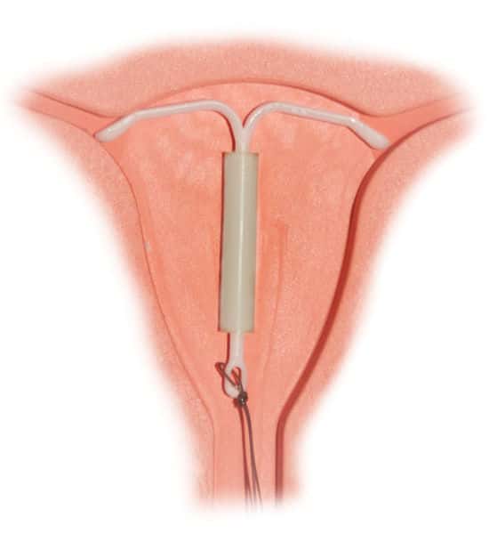 Le stérilet hormonal, ici à l'image, relargue dans l'organisme une progestérone de synthèse qui dérègle le cycle menstruel. Il suffit bien sûr de le retirer pour retrouver une fertilité normale. © Gloecknerd, Wikipédia, DP