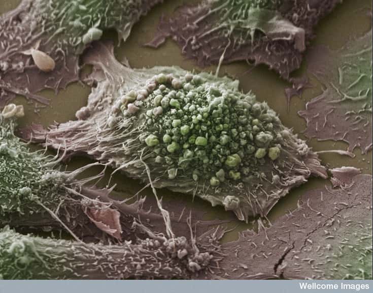 Ces cellules du cancer du poumon seront détruites par un médicament anti-PD-1, poussant le système immunitaire à les éliminer. © Anne Weston, Wellcome Images, Flickr, cc by nc nd 2.0