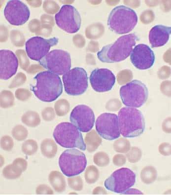 On classe la leucémie parmi les cancers du sang. Il s'agit d'une tumeur qui s'attaque à la moelle osseuse, l'organe chargé de fabriquer les composants du sang, comme les globules rouges ou les globules blancs. À l'image, des cellules précurseurs des lymphocytes B (système immunitaire) atteintes de leucémie. © VashiDonsk, Wikipédia, cc by sa 3.0
