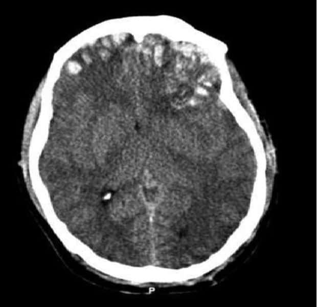 Cette image obtenue par scanner montre un traumatisme crânien. Le crâne a été déformé suite à un choc qui lèse certaines régions du cerveau. Il n'est pas toujours mortel mais peut entraîner de lourdes conséquences neurologiques. © Rehman <em>et al.</em>, Wikipédia, cc by 2.0